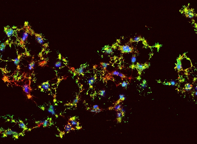 Dying human cancer cells are labeled with flourescent dyes to show DNA (blue), actin (red), and active caspase 3 (green)