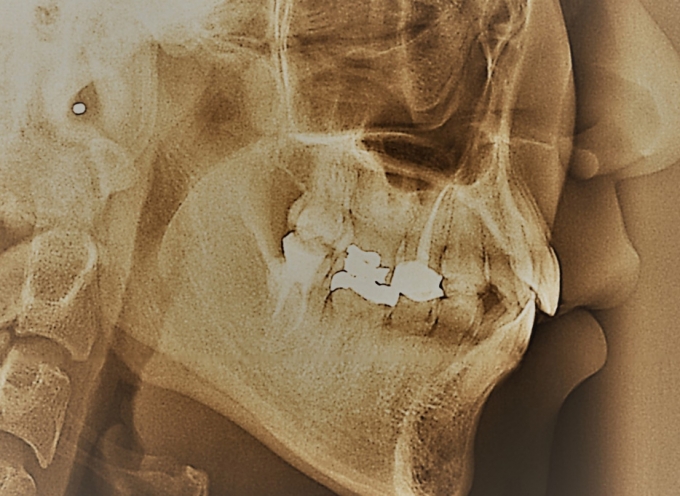 Teeth X-Ray